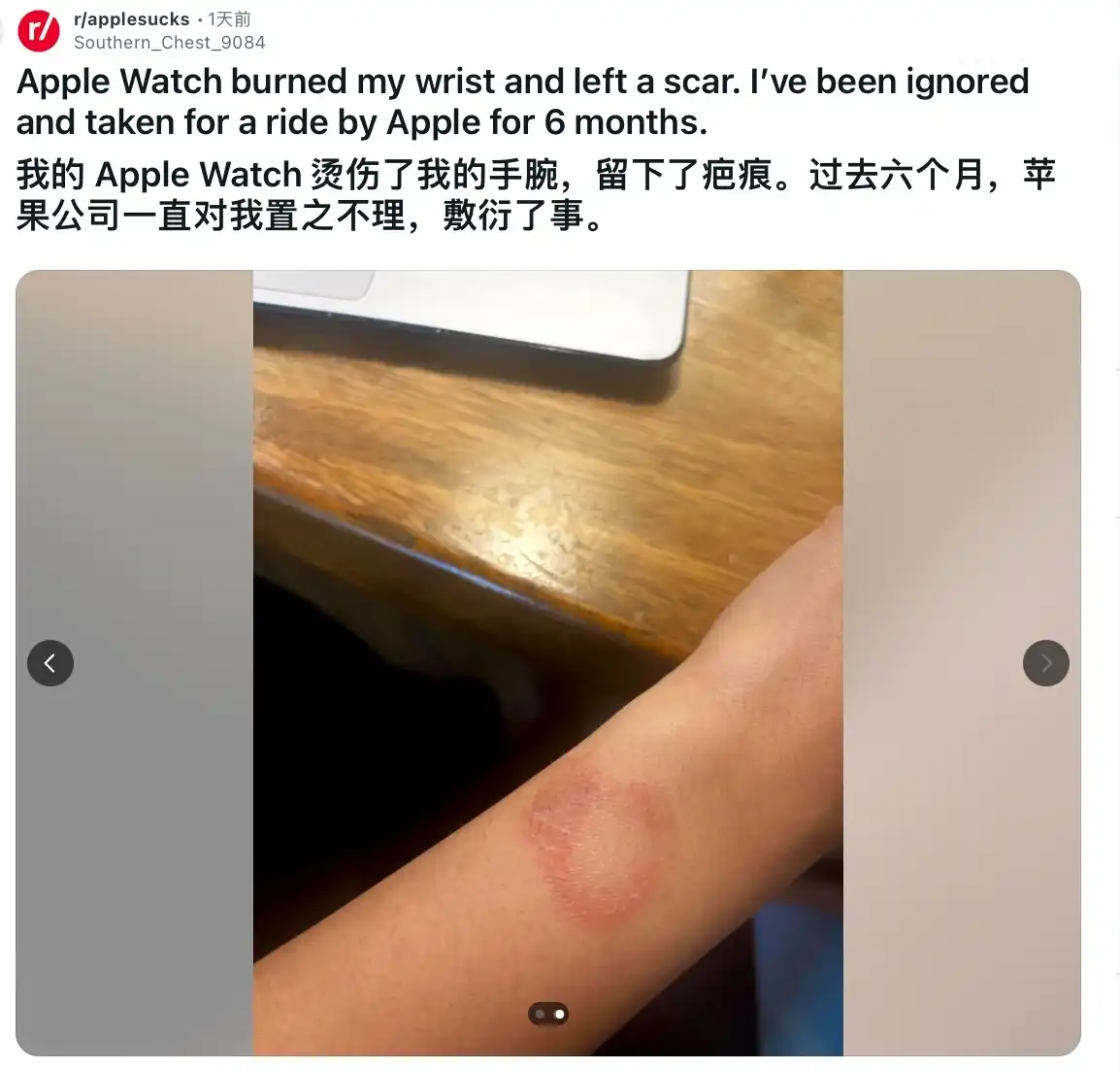 印度用户被苹果 Apple Watch 手表灼伤手腕，维权半年无果插图